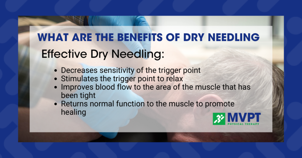 What are the benefits of dry needling?
